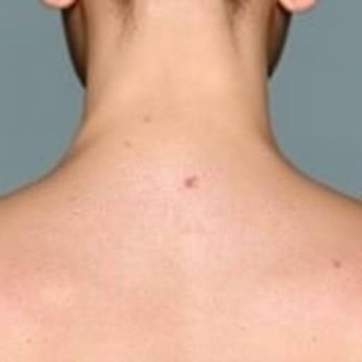 What Patients Should Know About Mohs Surgery and Skin Cancer Recurrence